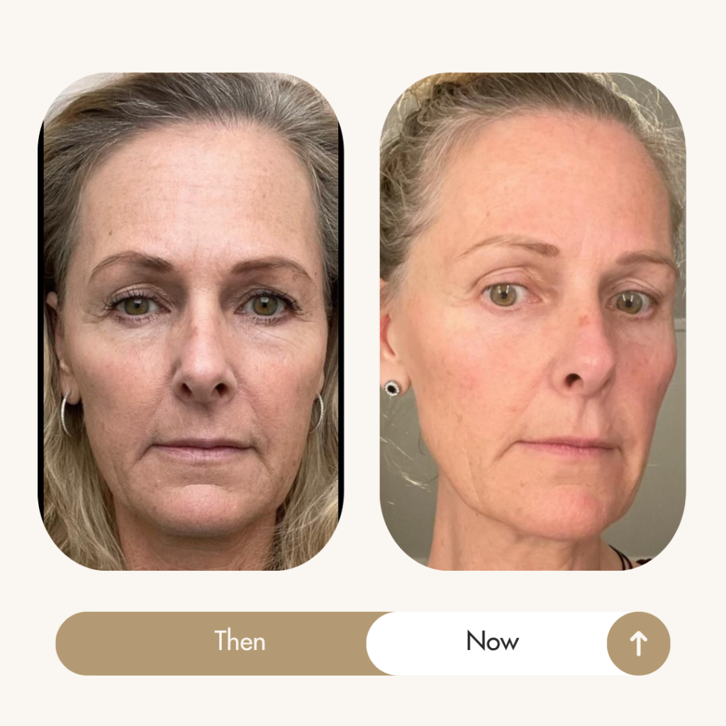 Lisa, 59, progress face HIIT by Sadie Nardini