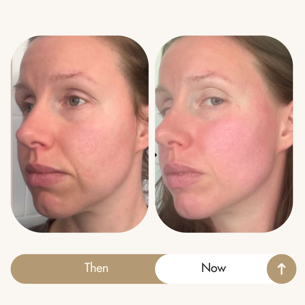 Face HIIT results: Helena, 38 — mouth, chin and eye area