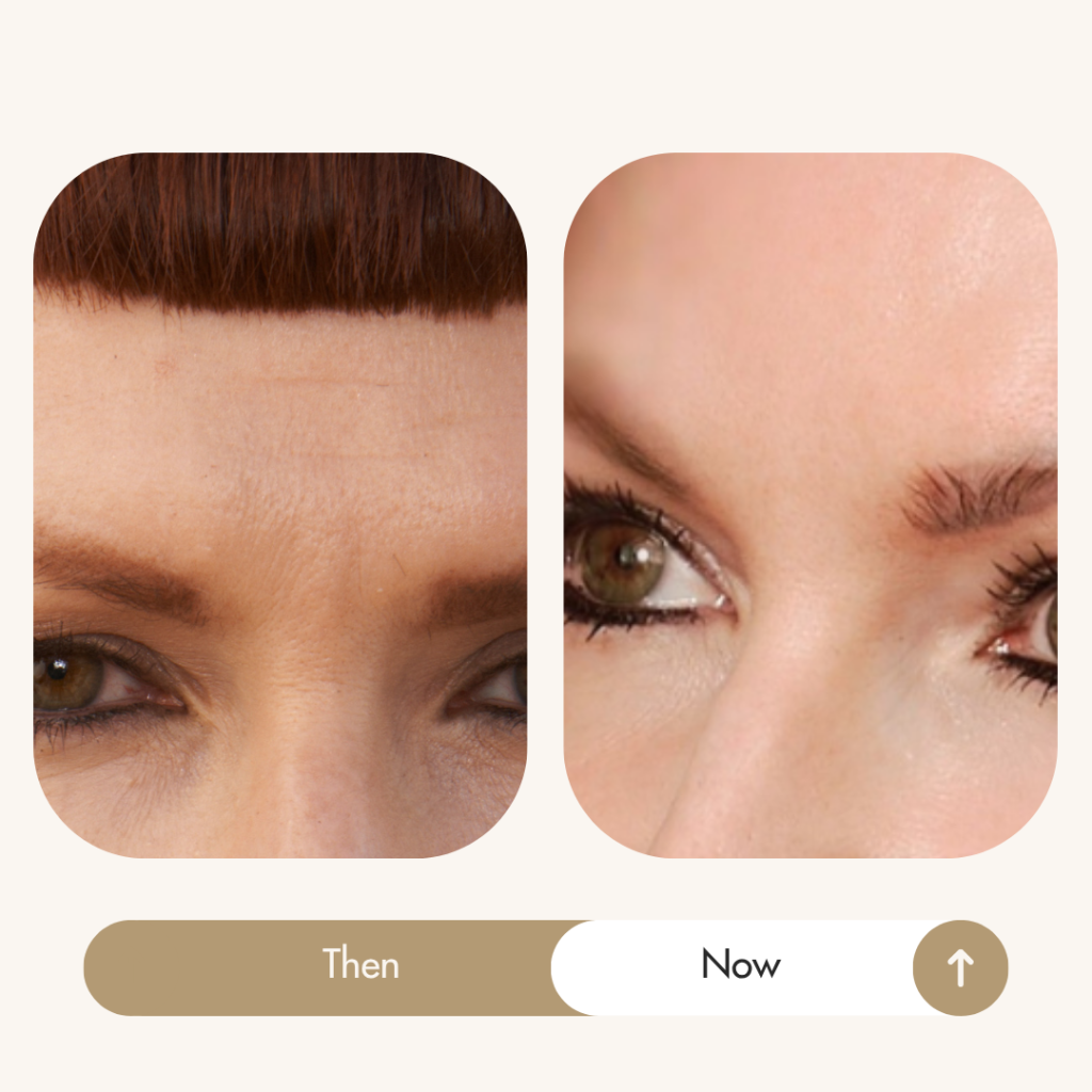 Sadie Nardini Face HIIT results: forehead lines smoothed, before and after