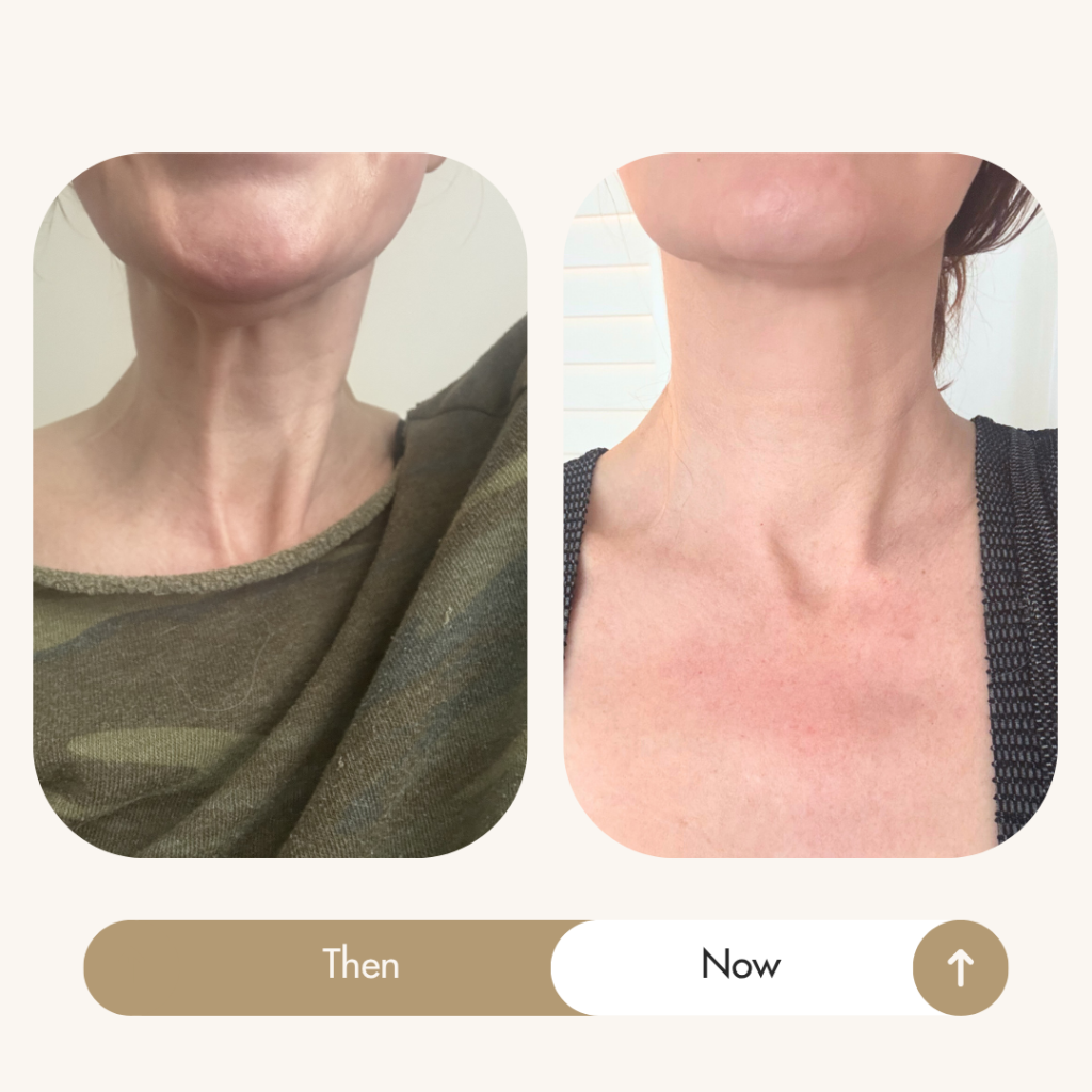Sadie Nardini Face HIIT neck results: neck ropes and sagging improved